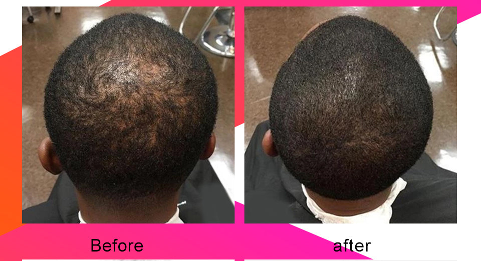Fast Hair Growth Traction Alopecia Chebe Anti Hair Break